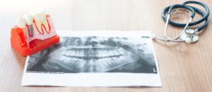 photo of an xray of a mouth next to a dental implant model at a dentist's desk