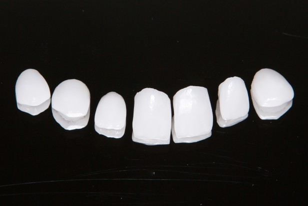 Veneers vs Crowns: What’s the Difference?