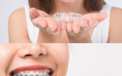 Exploring Clear Aligners as an Alternative to Metal Braces