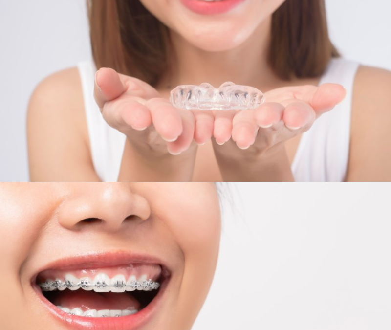 two photos stacked vertically on top a women is holding a pair of clear aligners and on the bottom a woman is smiling with braces on her teeth
