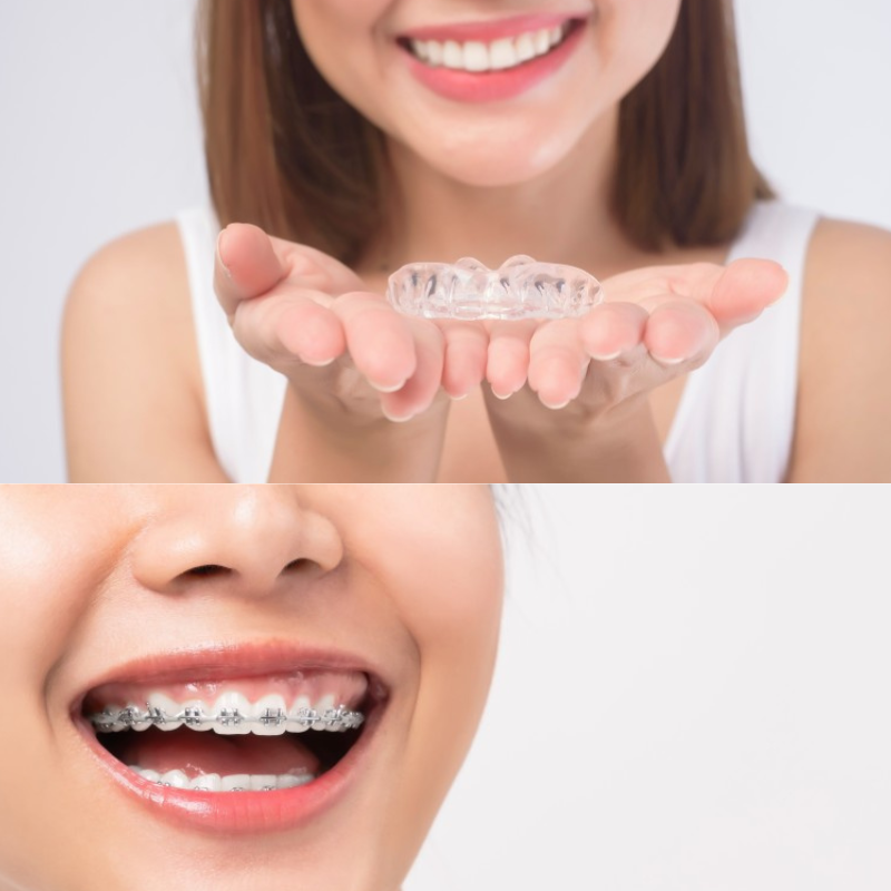 What type of orthodontics to choose?: Invisible brackets and aligners