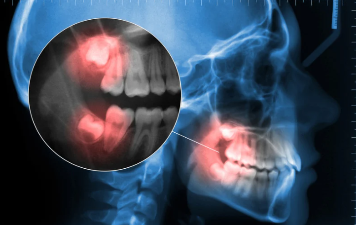 Everything you need to know about Wisdom Teeth